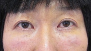 目の下の膨らみと凹みが混在した方に　DR.近藤オリジナル　TCB-R法