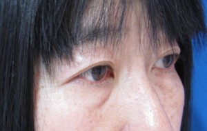 目の下の膨らみと凹みが混在した方に　DR.近藤オリジナル　TCB-R法