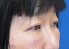 目の下の膨らみと凹みが混在した方に　DR.近藤オリジナル　TCB-R法
