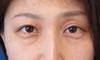 DR近藤オリジナル　切らない目の下のくま・たるみ取り（マイクロサージャリー）