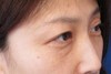 DR近藤オリジナル　切らない目の下のくま・たるみ取り（マイクロサージャリー）