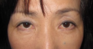 目の下の膨らみ・たるみと凹みラインが混合したタイプの方に  ＴＣＢ−Ｒ　コンプリート法（顕微鏡治療）