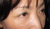 目の下の膨らみと凹みラインが混在した方に　DR近藤オリジナル　切らない目の下のクマ・たるみ取り　＋　ラディエッセ注入　（TCB-R 法）　