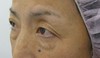 目の下の膨らみと凹みラインが混在した方に　DR近藤オリジナル　切らない目の下のクマ・たるみ取り　＋　ラディエッセ注入　（TCB-R 法）　