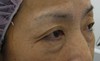 目の下の膨らみと凹みラインが混在した方に　DR近藤オリジナル　切らない目の下のクマ・たるみ取り　＋　ラディエッセ注入　（TCB-R 法）　