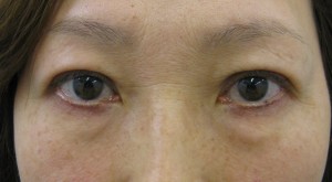 DR.近藤オリジナル　切らない目の下のクマ・たるみ取り（術直後写真）