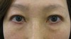 DR近藤オリジナル　切らない目の下のクマ・たるみ取り（術後6週）