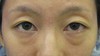 DR近藤オリジナル　切らない目の下のくま・たるみ取り（術直後写真）