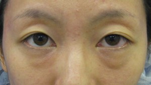 DR近藤オリジナル　切らない目の下のくま・たるみ取り（術直後写真）