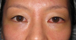 DR近藤オリジナル　切らない目の下のくま・たるみ取り（術直後写真）