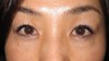 DR.近藤オリジナル　切らない目の下のクマ・たるみ取り　術後5週