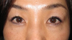DR.近藤オリジナル　切らない目の下のクマ・たるみ取り　術後5週