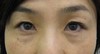 DR.近藤オリジナル　切らない目の下のクマ・たるみ取り　術後5週