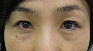 DR.近藤オリジナル　切らない目の下のクマ・たるみ取り　術後5週