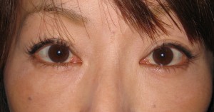 私の目指す美容外科　最小侵襲アンチエイジング外科（MIAS)　DR近藤オリジナル　切らない目の下のクマ・たるみ取り(術後3ヶ月）