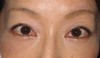 私の目指す美容外科　最小侵襲アンチエイジング外科（MIAS)　DR近藤オリジナル　切らない目の下のクマ・たるみ取り(術後3週）