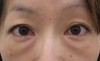 私の目指す美容外科　最小侵襲アンチエイジング外科（MIAS)　DR近藤オリジナル　切らない目の下のクマ・たるみ取り(術後3ヶ月）