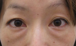 私の目指す美容外科　最小侵襲アンチエイジング外科（MIAS)　DR近藤オリジナル　切らない目の下のクマ・たるみ取り(術後3ヶ月）