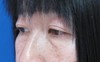 目の下の膨らみと凹みが混在した方に　切らない目の下のクマ・たるみ取り　TCB-R　コンプリート法　