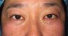 DR近藤オリジナル　切らない目の下のくま・たるみ取り　自己再生TCB