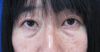 DR近藤オリジナル　切らない目の下のくま・たるみ取り　自己再生TCB