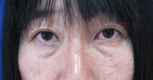 DR近藤オリジナル　切らない目の下のくま・たるみ取り　自己再生TCB