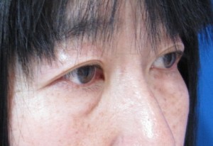 目の下の膨らみと凹みが混在した方に　切らない目の下のクマ・たるみ取り　TCB-R　コンプリート法　