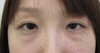 DR近藤オリジナル　切らない目の下のくま・たるみ取り（術直後写真）