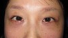 DR近藤オリジナル　切らない目の下のくま・たるみ取り（術直後写真）