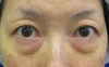 目の下の膨らみと凹みラインが混在した方に　DR近藤オリジナル　切らない目の下のクマ・たるみ取り　＋　ラディエッセ注入　（TCB-R 法）