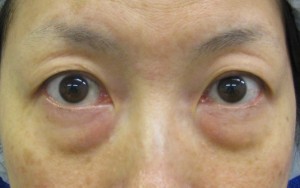 目の下の膨らみと凹みラインが混在した方に DR近藤オリジナル 切らない目の下のクマ・たるみ取り + ラディエッセ注入 (TCB-R 法)