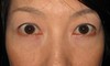 目の下の膨らみと凹みラインが混在した方に　DR近藤オリジナル　切らない目の下のクマ・たるみ取り　＋　ラディエッセ注入　（TCB-R 法）