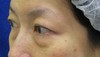 目の下の膨らみと凹みラインが混在した方に　DR近藤オリジナル　切らない目の下のクマ・たるみ取り　＋　ラディエッセ注入　（TCB-R 法）