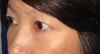 目の下の膨らみと凹みラインが混在した方に　DR近藤オリジナル　切らない目の下のクマ・たるみ取り　＋　ラディエッセ注入　（TCB-R 法）