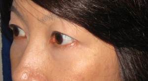 目の下の膨らみと凹みラインが混在した方に DR近藤オリジナル 切らない目の下のクマ・たるみ取り + ラディエッセ注入 (TCB-R 法)
