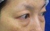 目の下の膨らみと凹みラインが混在した方に　DR近藤オリジナル　切らない目の下のクマ・たるみ取り　＋　ラディエッセ注入　（TCB-R 法）