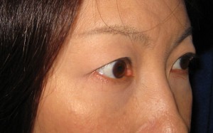 目の下の膨らみと凹みラインが混在した方に DR近藤オリジナル 切らない目の下のクマ・たるみ取り + ラディエッセ注入 (TCB-R 法)