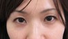 DR近藤オリジナル　切らない目の下のくま・たるみ取り（術半年後写真）