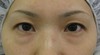 DR近藤オリジナル　切らない目の下のくま・たるみ取り（術半年後写真）