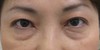 私の目指す美容医療　最小侵襲アンチエイジング外科　MIAS：　DR近藤オリジナル　切らない目の下のクマ　たるみ取り