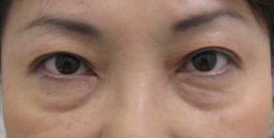 私の目指す美容医療　最小侵襲アンチエイジング外科　MIAS：　DR近藤オリジナル　切らない目の下のクマ　たるみ取り