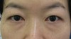 DR近藤オリジナル　切らない目の下のくま・たるみ取り（術直後写真）
