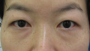 DR近藤オリジナル　切らない目の下のくま・たるみ取り（術直後写真）