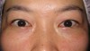 DR近藤オリジナル　切らない目の下のくま・たるみ取り（術直後写真）
