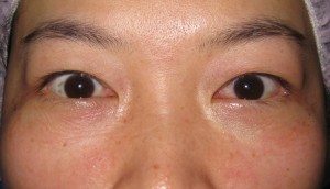 DR近藤オリジナル　切らない目の下のくま・たるみ取り（術直後写真）