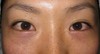 DR近藤オリジナル　切らない目の下のたるみ取り　術直後
