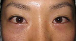 DR近藤オリジナル　切らない目の下のクマ・たるみ取り　（術直後写真）