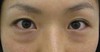 DR近藤オリジナル　切らない目の下のたるみ取り　術直後
