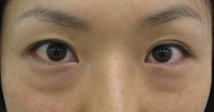 DR近藤オリジナル　切らない目の下のたるみ取り　術直後