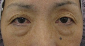 目の下の膨らみ・たるみと凹みラインが混合したタイプの方に  ＴＣＢ−Ｒ　コンプリート法（顕微鏡治療）
